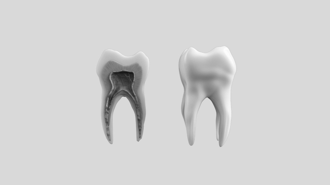 Gingivitis