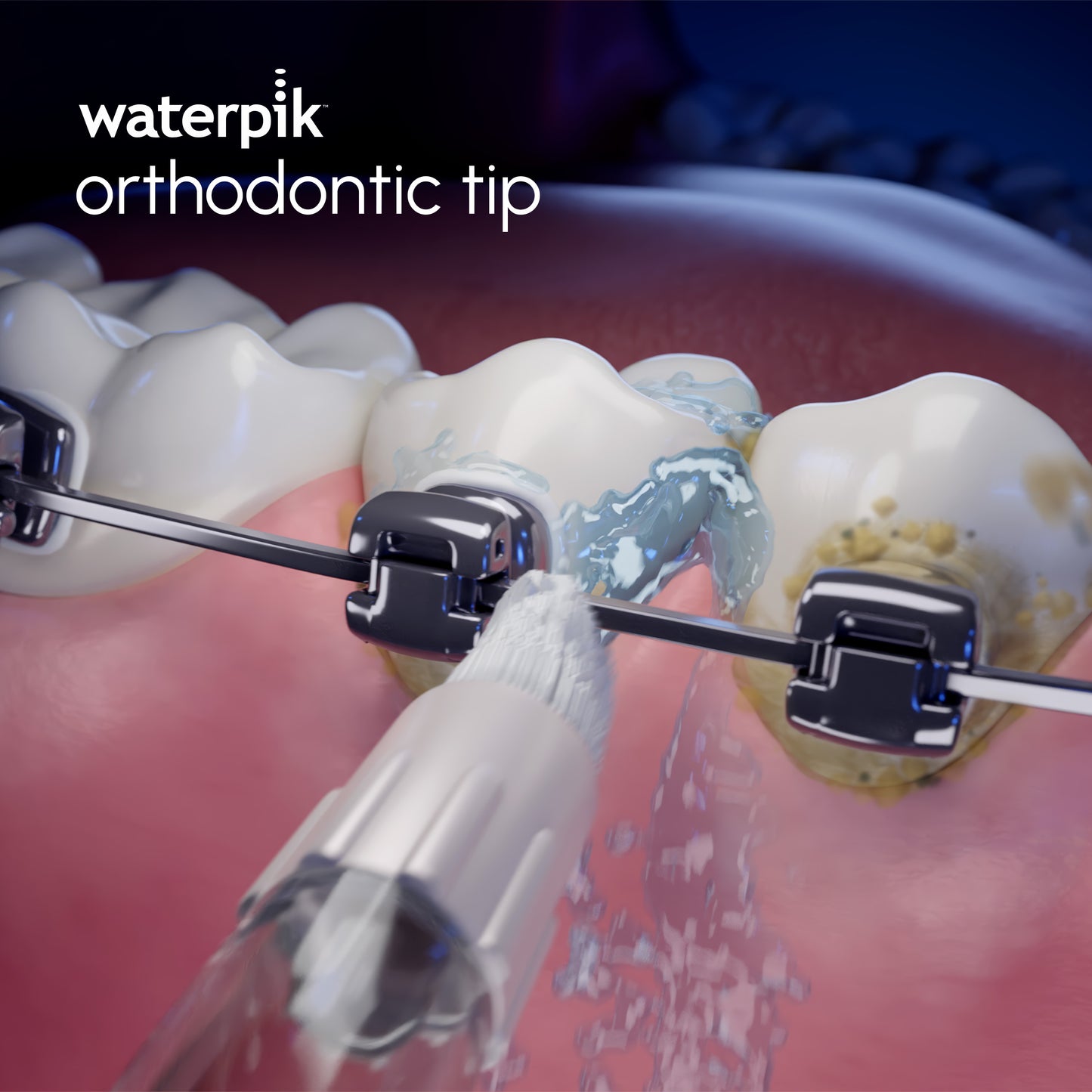 Embout orthodontique