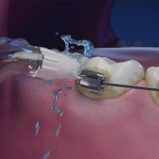 Embout orthodontique