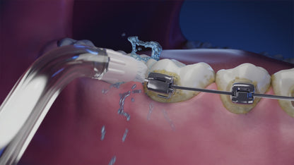 Embout orthodontique