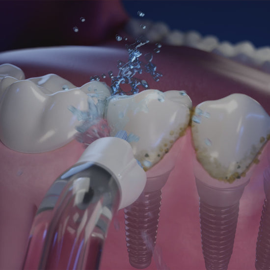 Embout implants, bridges et couronnes