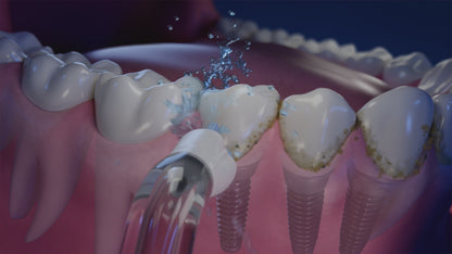 Embout implants, bridges et couronnes